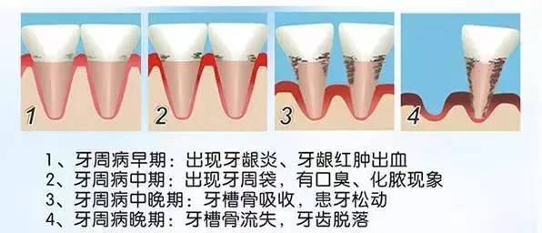 牙齿松了还能恢复吗？如何固齿？日常做到这6点，牙齿还保得住