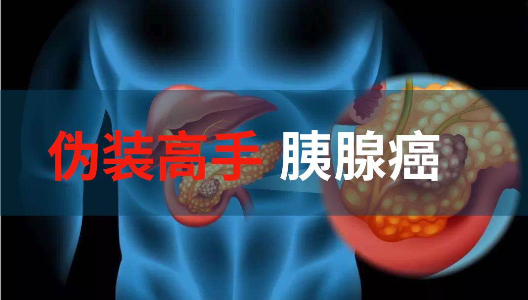 浅谈“癌中之王”——胰腺癌，早期发现很重要，注意这一点症状