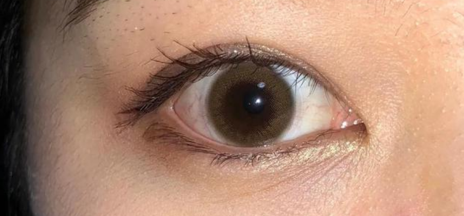 眼白发黄后我看上去老了10岁