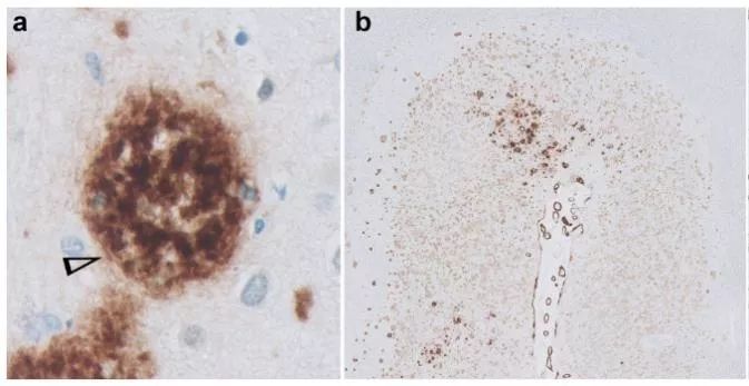 刷新认知！原来大脑中的免疫细胞是个喜欢斑块（Aβ）的“吃货”！