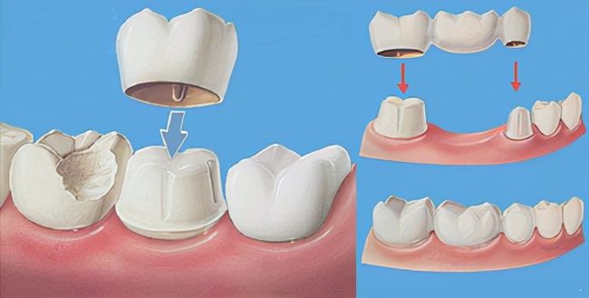 牙齿固定桥修复图片图片