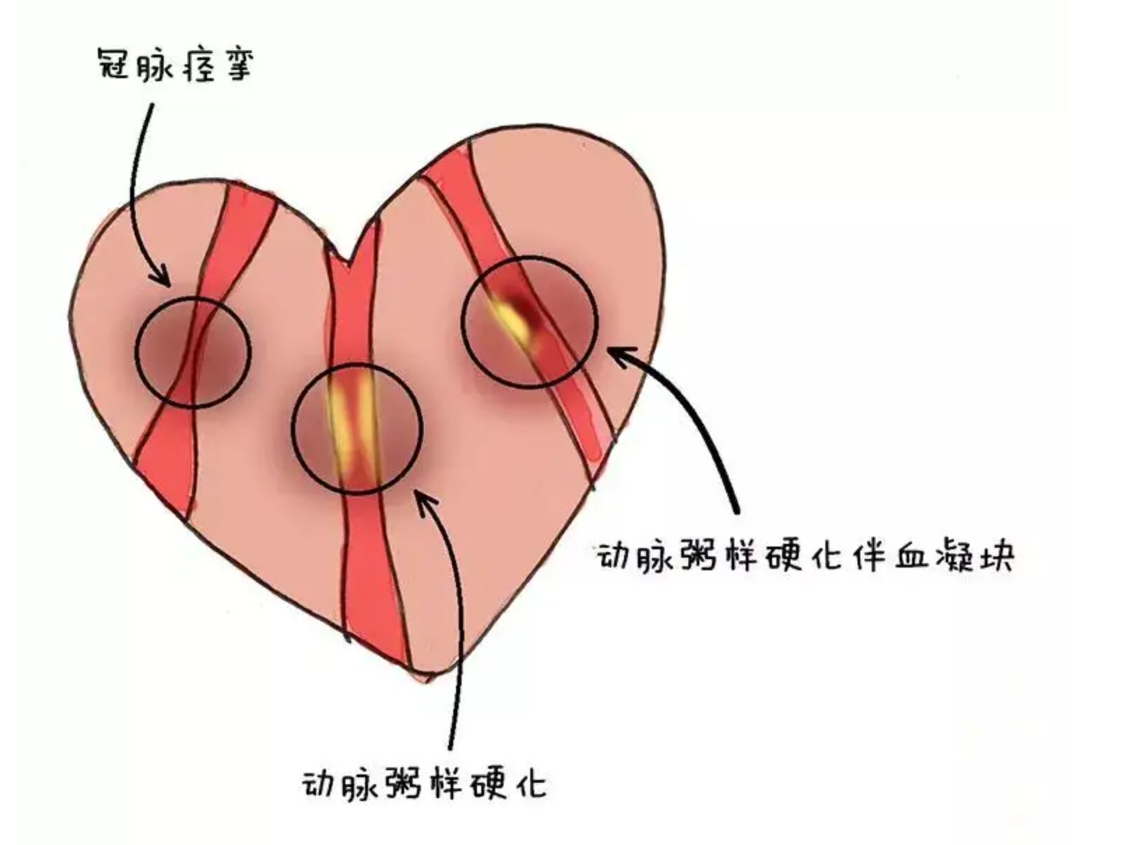 这几年患心梗的人增多哪些人群易发探讨心梗的病因表现预防