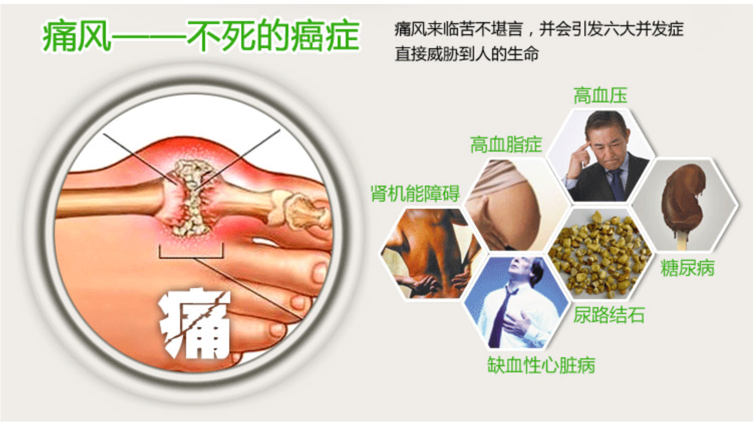 痛风越来越常见探讨痛风的病因治疗和预防请收藏
