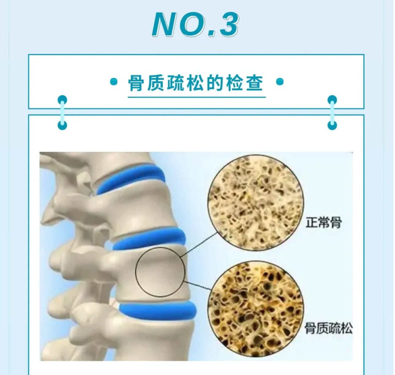 骨质疏松症：多么痛的领悟