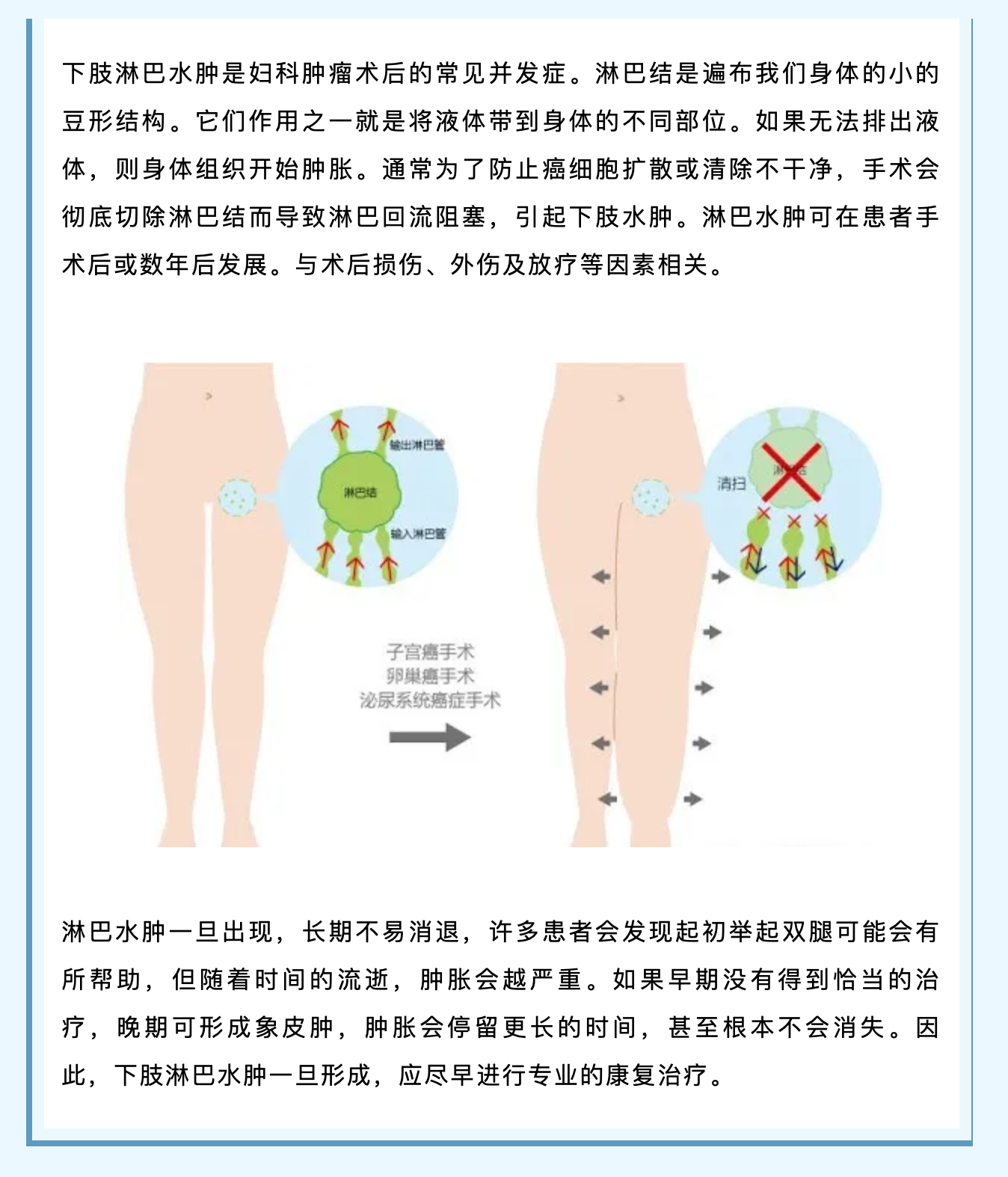 妇科肿瘤术后，如何预防下肢肿胀？