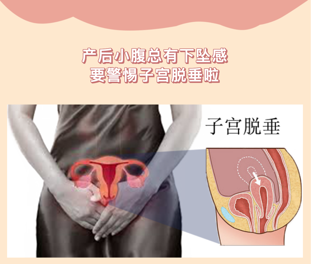 產(chǎn)后小腹總有下墜感，要警惕子宮脫垂啦