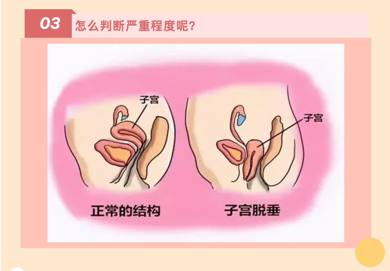 產(chǎn)后小腹總有下墜感，要警惕子宮脫垂啦
