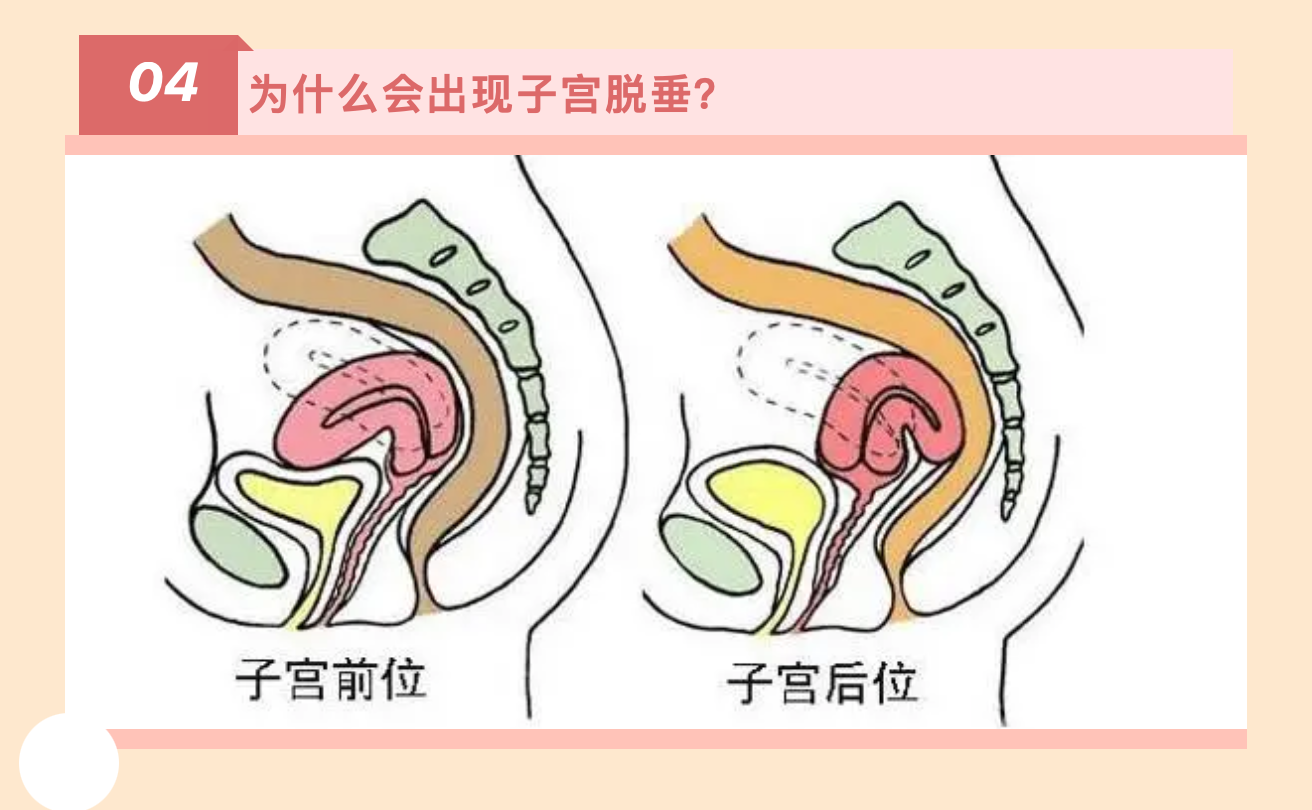 產(chǎn)后小腹總有下墜感，要警惕子宮脫垂啦