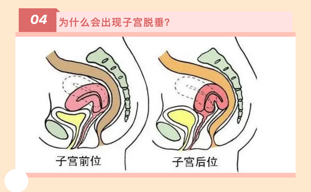 產(chǎn)后小腹總有下墜感，要警惕子宮脫垂啦