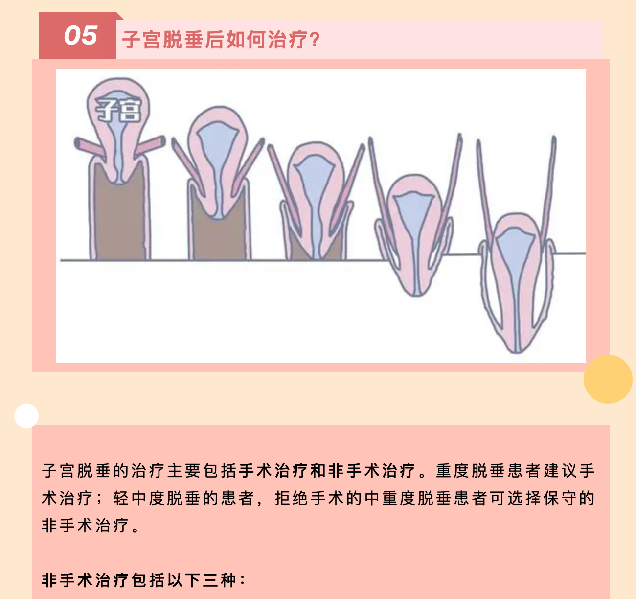 產(chǎn)后小腹總有下墜感，要警惕子宮脫垂啦