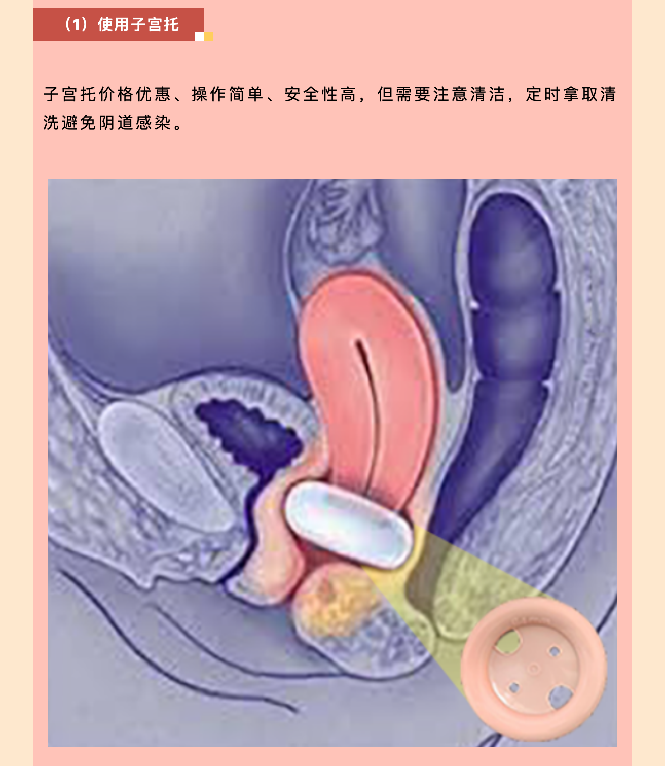 產(chǎn)后小腹總有下墜感，要警惕子宮脫垂啦