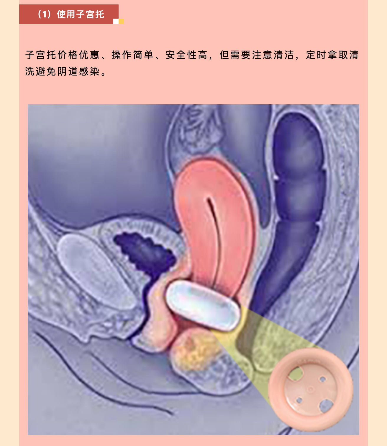 產(chǎn)后小腹總有下墜感，要警惕子宮脫垂啦