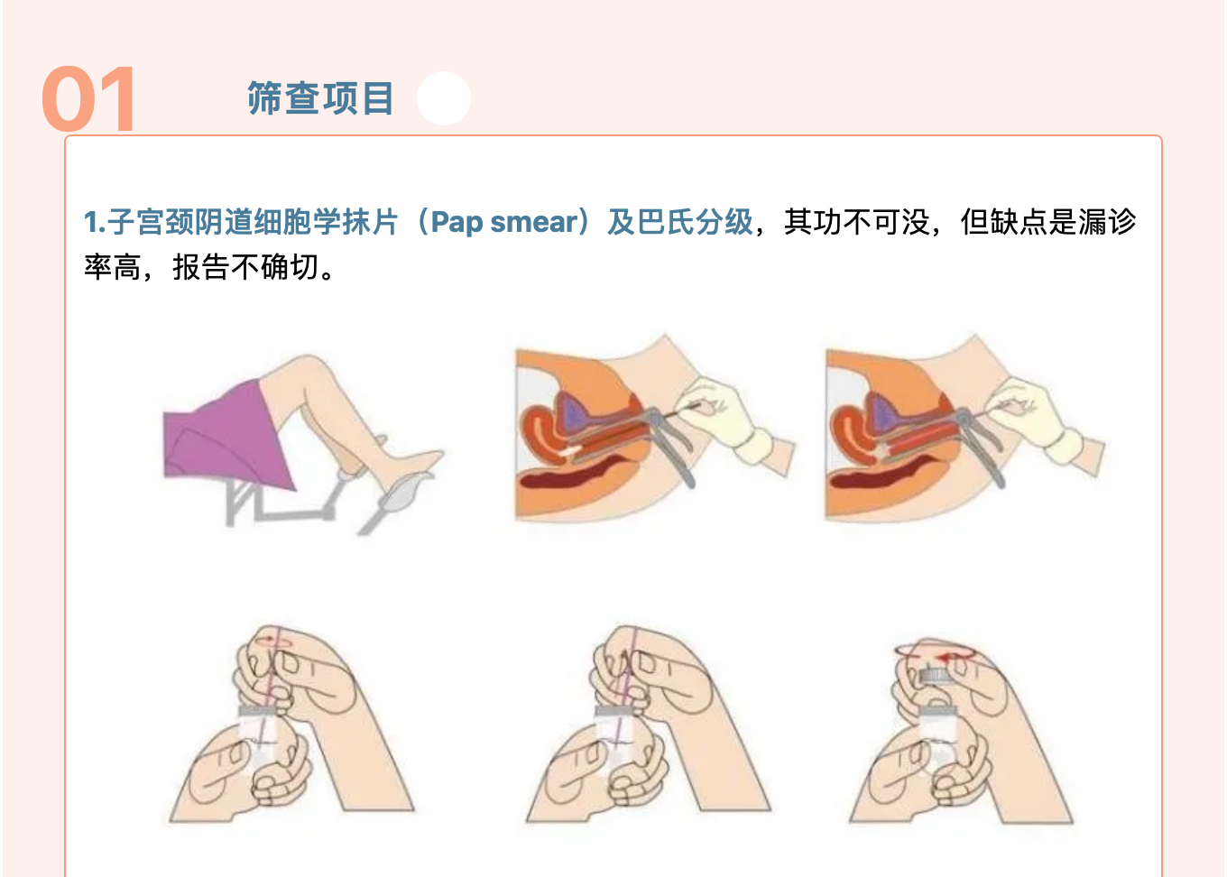 規(guī)范化篩查，遠離宮頸腫瘤