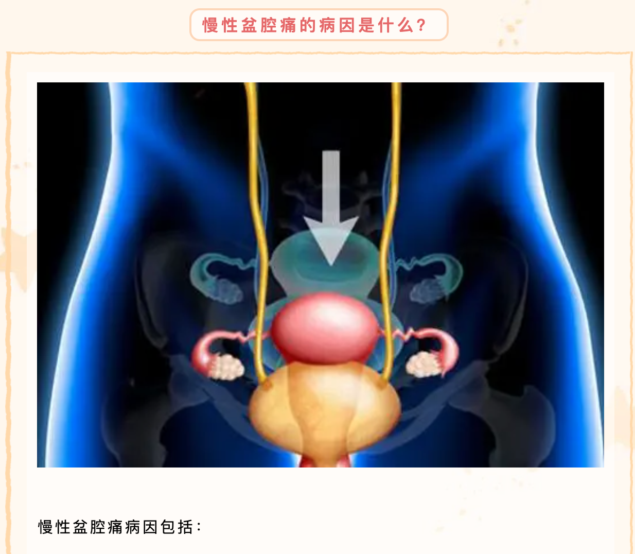 女性慢性盆腔痛原因