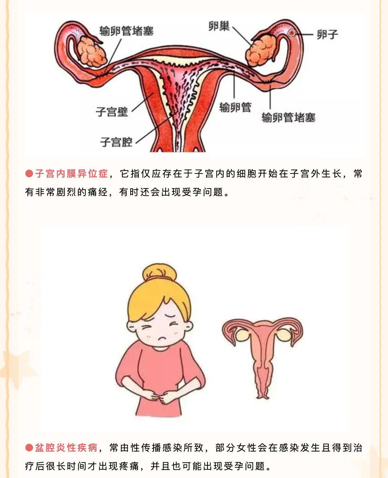 女性慢性盆腔痛原因