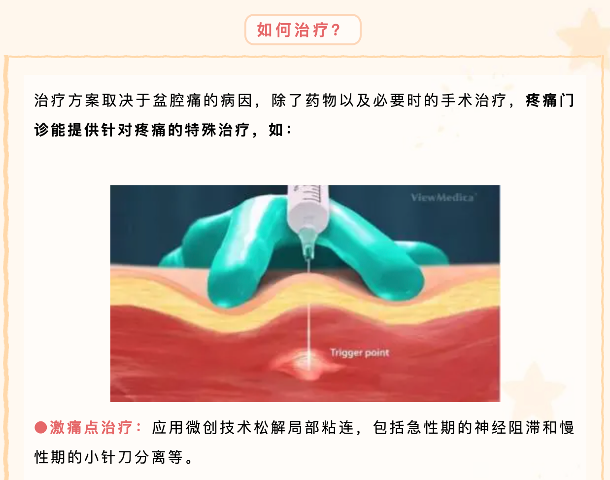 女性慢性盆腔痛原因