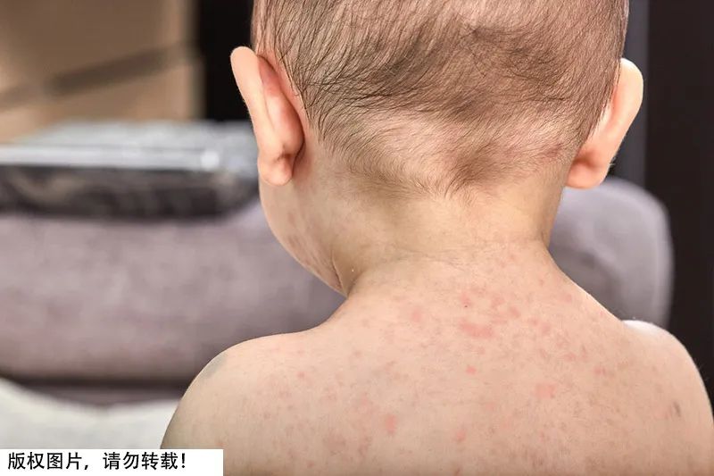 已发生人际传播和天花一个家族如何预防