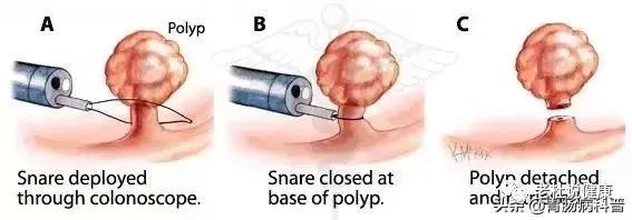 消化病学 | 90%的肠癌一发现就是中晚期！如何才能早期发现？