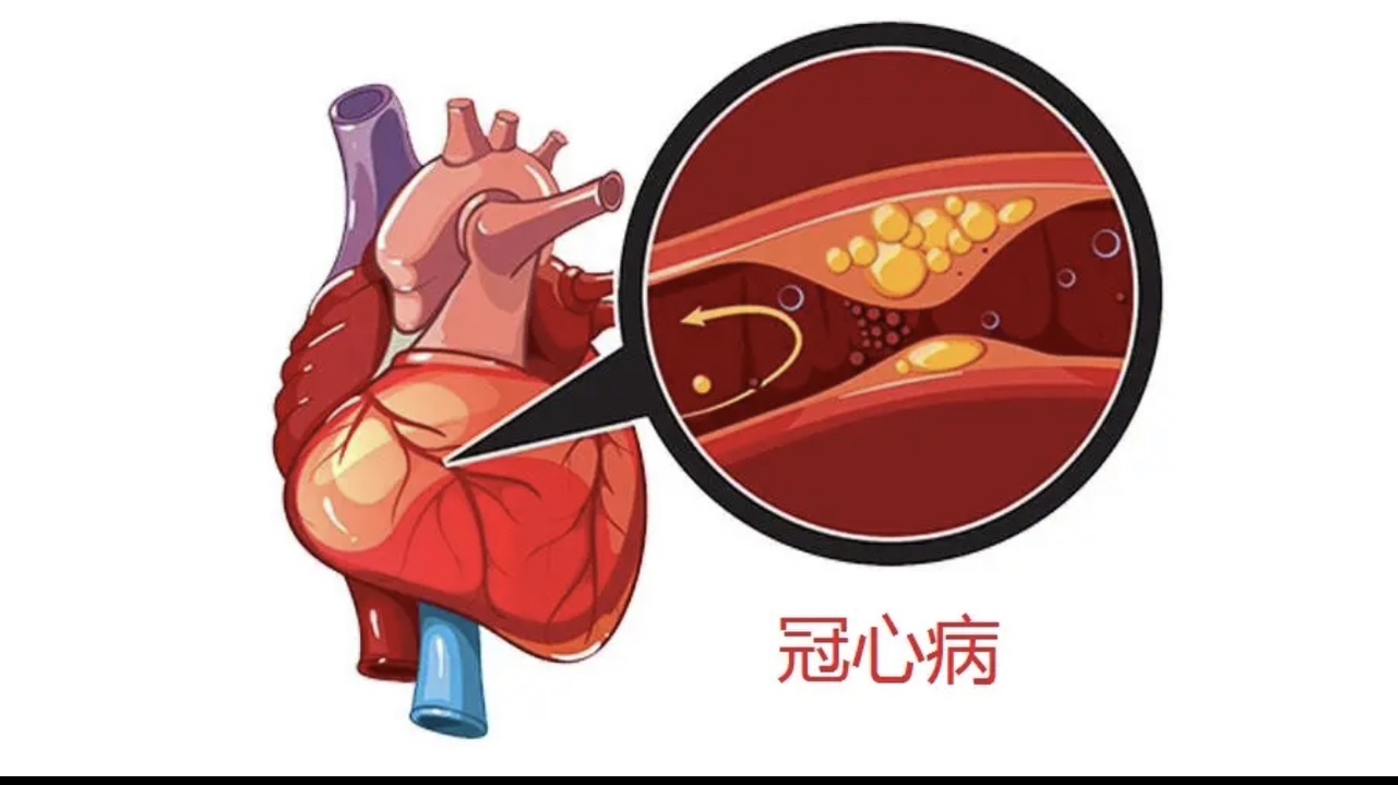 冠心病的常见治疗误区,你都知道吗？