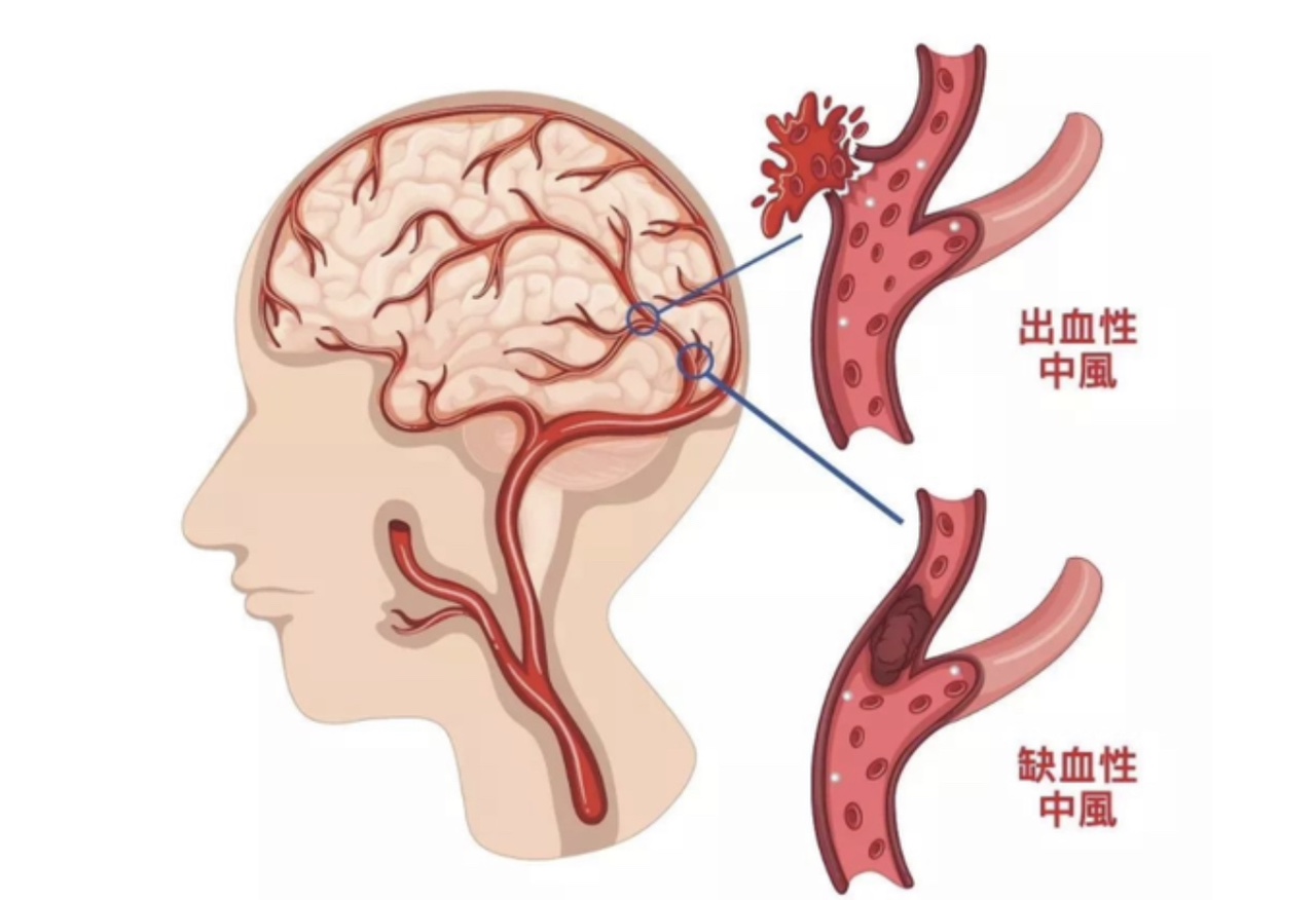 脑出血前身体会发出这些信号