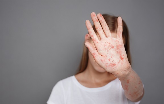 只有接触麻疹患者皮肤发病处才会传染吗？