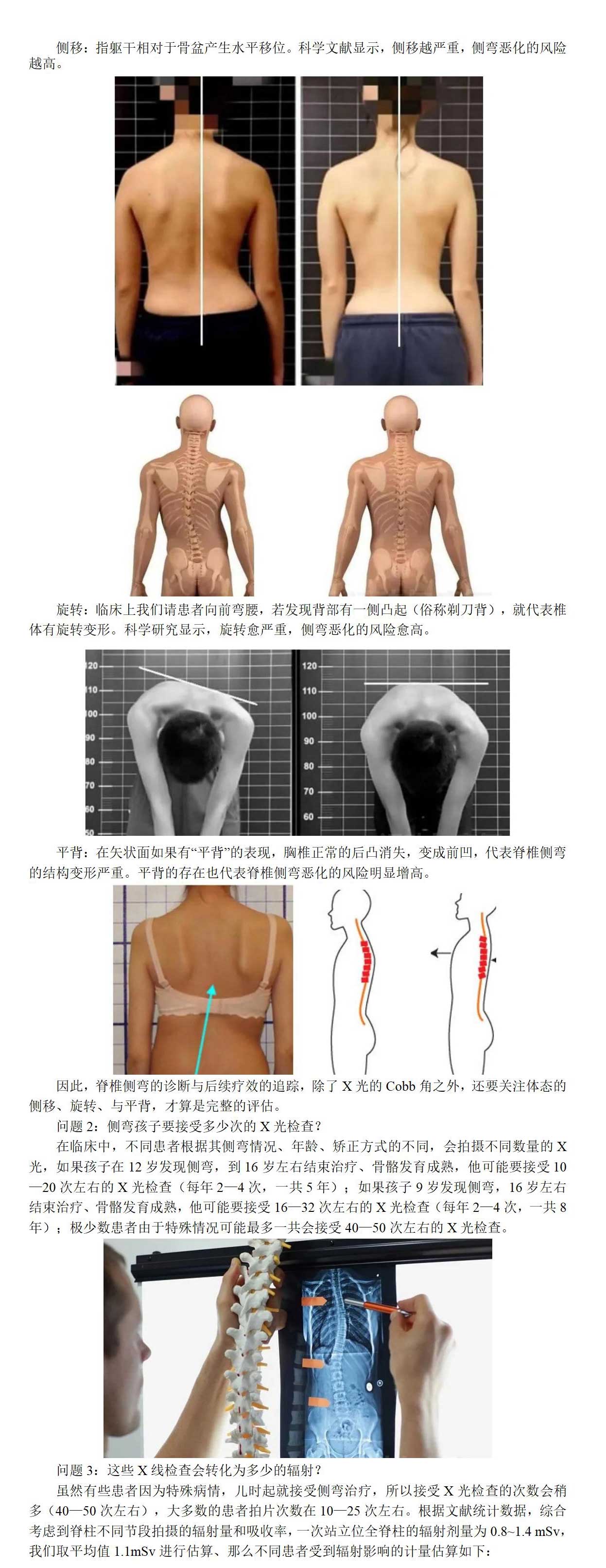 关于全脊柱X光片,家长最希望知道的一些问题!_01_03.jpg