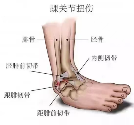 “医”说就懂 | 崴脚，只有0次或者无数次？-第2张图片-大猪科技网