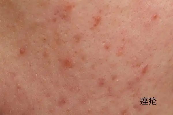 几块钱一管的维 A 酸乳膏，是“护肤圣品”还是致癌毒物？-第3张图片-大猪科技网