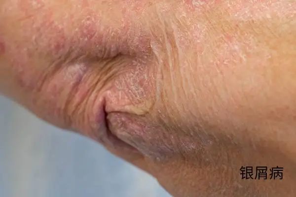 几块钱一管的维 A 酸乳膏，是“护肤圣品”还是致癌毒物？-第4张图片-大猪科技网