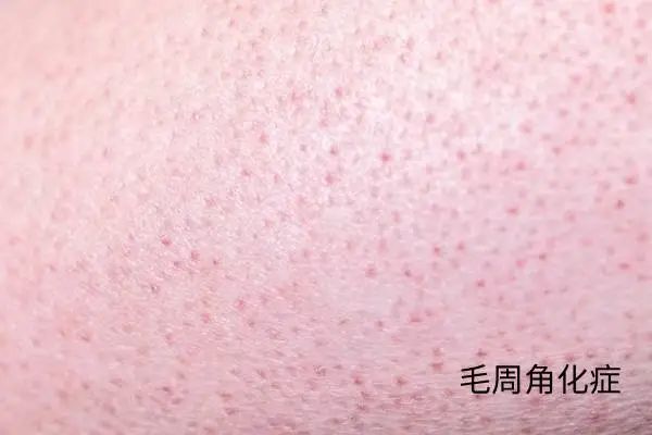 几块钱一管的维 A 酸乳膏，是“护肤圣品”还是致癌毒物？-第5张图片-大猪科技网