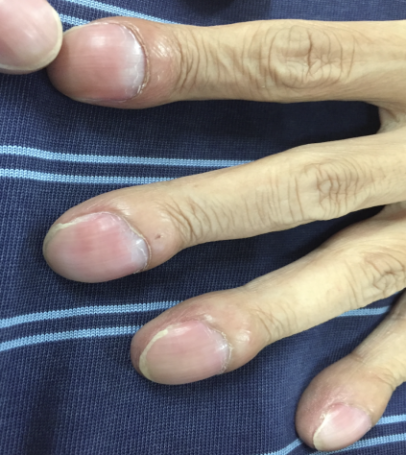 61杵状指:手指或足趾末端增生肥厚,指甲从根部到末端拱形隆起呈
