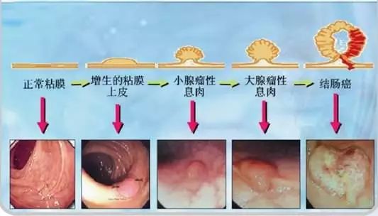 【胖熊科普】你以为它只是一个息肉，其实有可能是一个肿瘤！