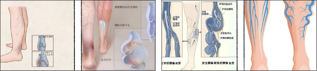 手术粘合用什么胶“医”说就懂丨胶水一粘,告别“蚯蚓腿”——静脉曲张微创治疗新技术全解析-上海聚慕医疗器械有限公司