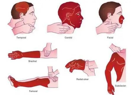 海姆立克腹部冲击法