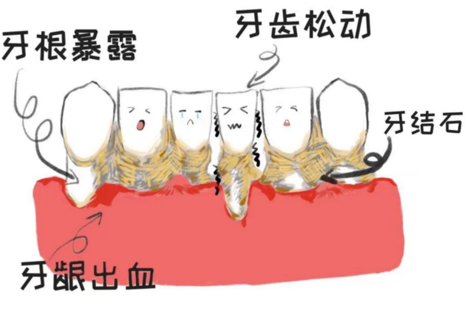【口腔健康系列科普6】摆脱牙结石的困扰