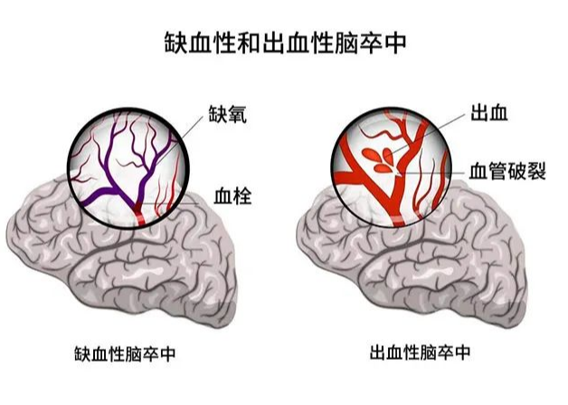 咳痰是身体在排毒？不同颜色的痰，预示不同的疾病！