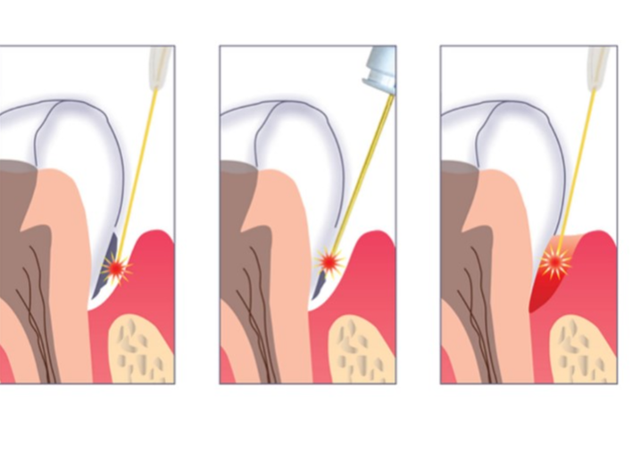 激光，牙周病治疗的利器
