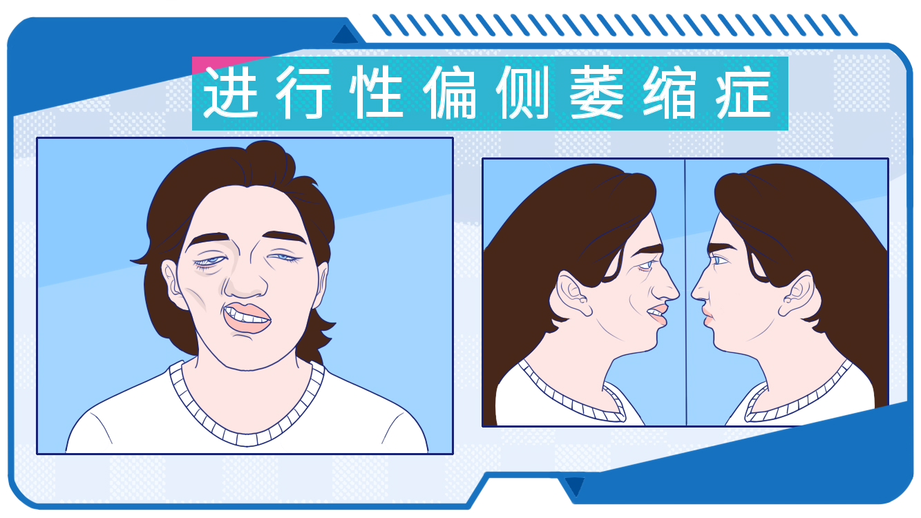 面部,四肢不对称?警惕进行性偏侧萎缩症!