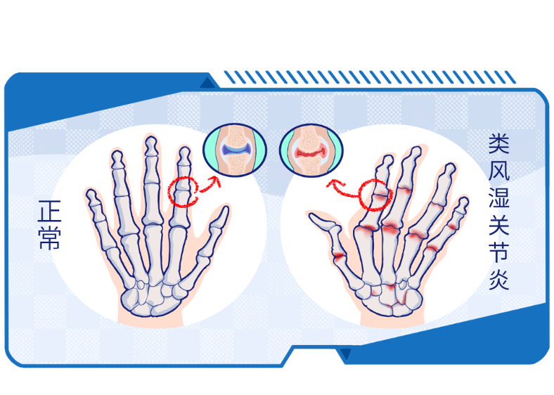 有一种痛叫类风湿关节炎的痛，被称为“不死的癌症”！