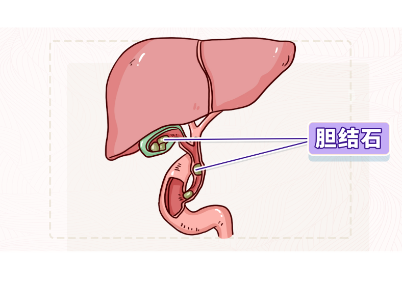 久坐不动、大鱼大肉，小心这种富贵病！