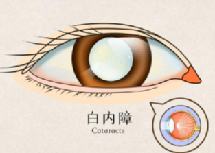 白内障术后注意些什么