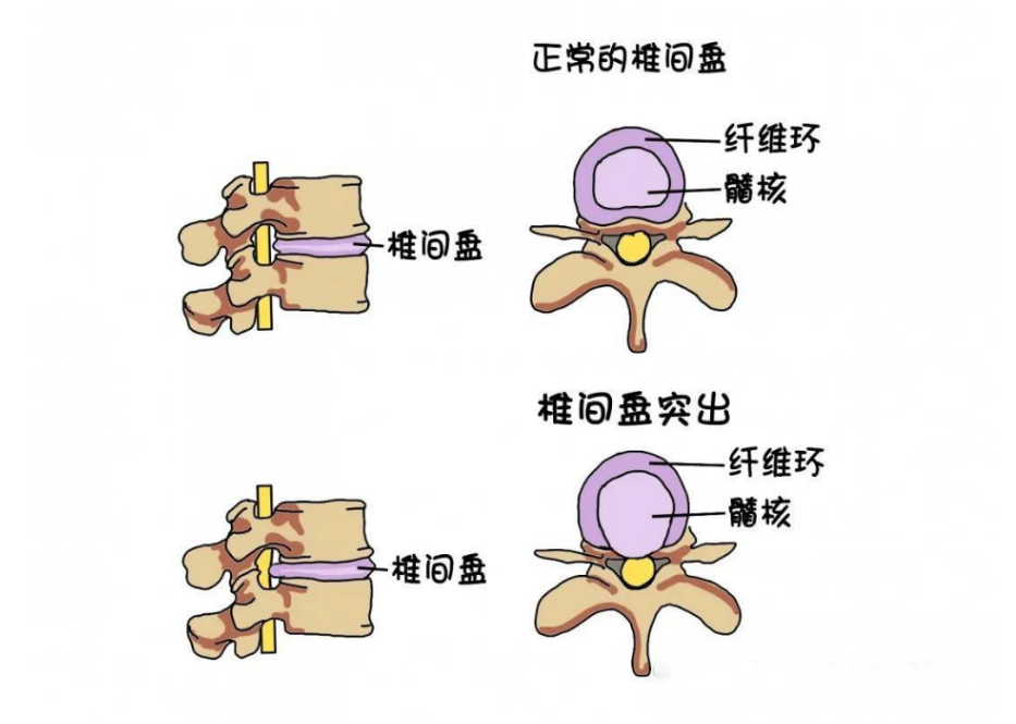 腰椎间盘突出症的康复治疗