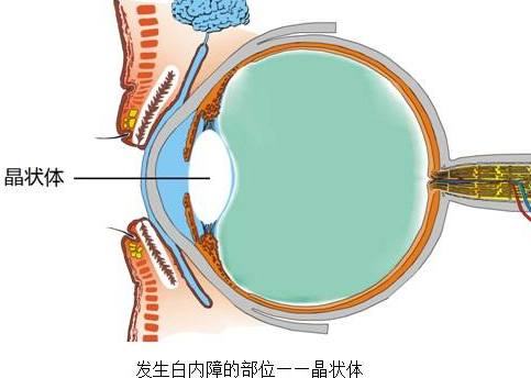 关于治疗白内障有效的办法！有什么“特效药”吗？