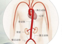 医学大咖话科普 | 夺命“三明治”——主动脉夹层