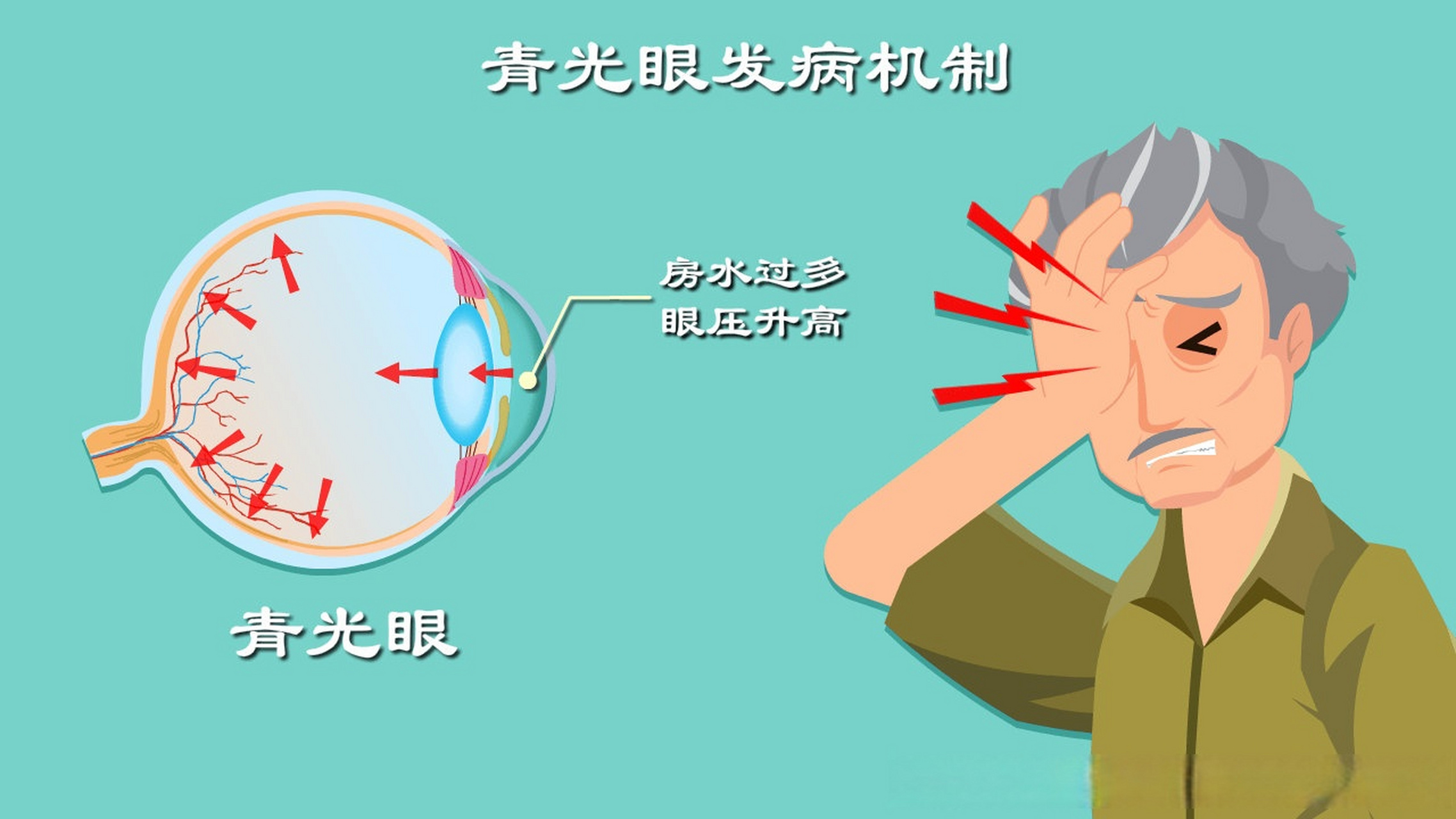 Hình ảnh mô tả về glaucom