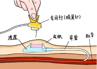Hệ thống truyền dịch tĩnh mạch