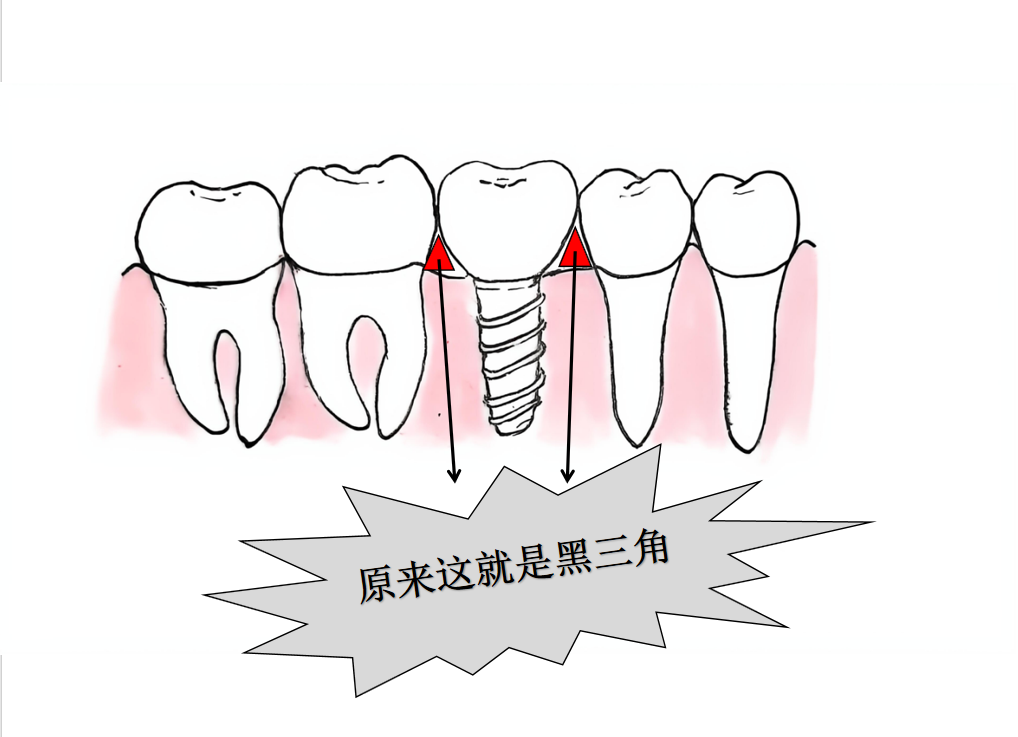 种植牙后怎么刷牙