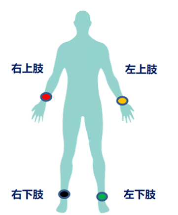 心电监护f n是什么一文读懂18导联心电图，比12导联更全面_https://www.jmylbn.com_新闻资讯_第5张