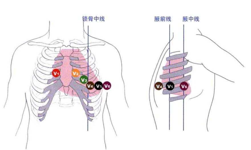 心电监护f n是什么一文读懂18导联心电图，比12导联更全面_https://www.jmylbn.com_新闻资讯_第6张