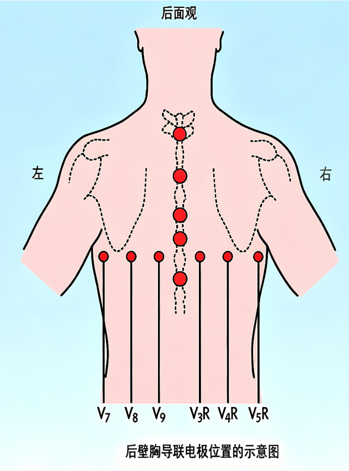 心电监护f n是什么一文读懂18导联心电图，比12导联更全面_https://www.jmylbn.com_新闻资讯_第8张